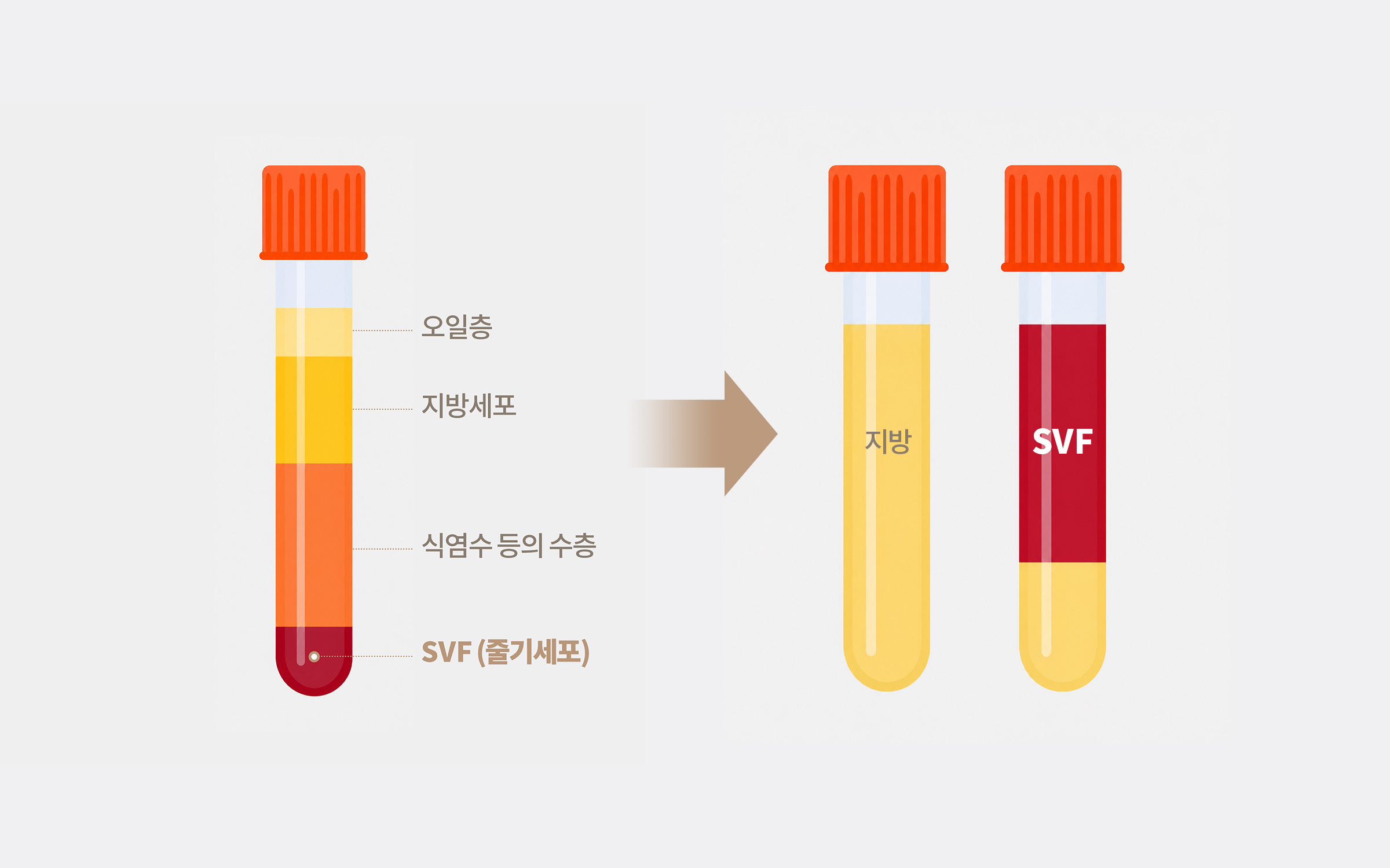 줄기세포 지방이식