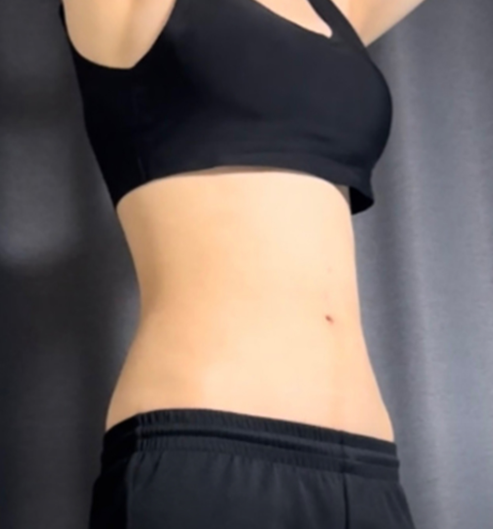 복부 지방흡입 이미지 3