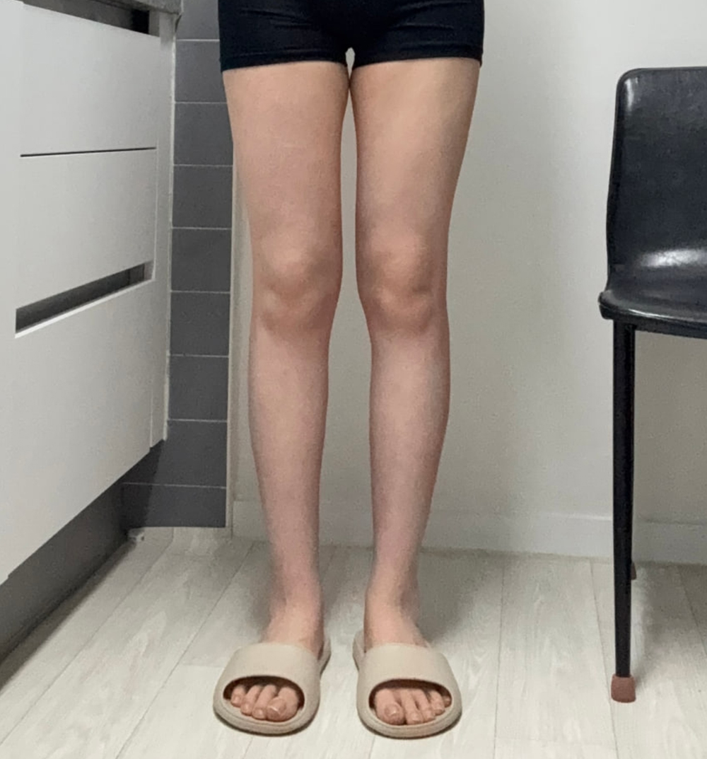 종아리 지방흡입 이미지 2