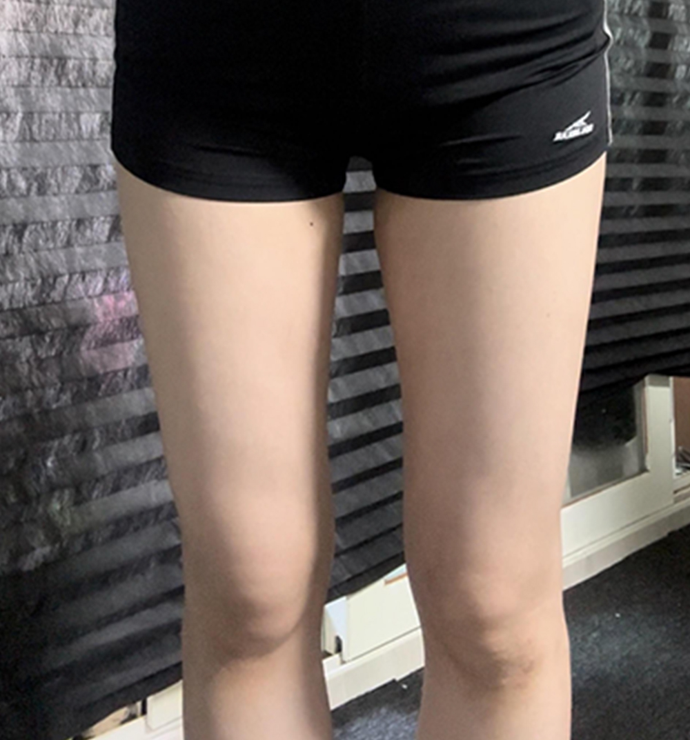 허벅지 지방흡입 이미지 1